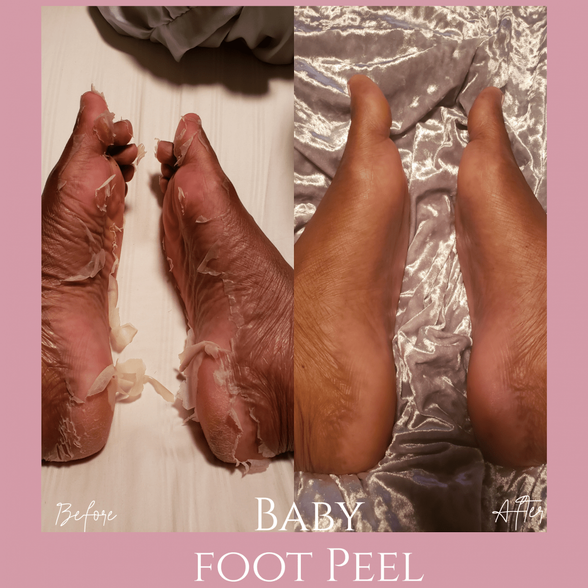 Baby Foot Peel